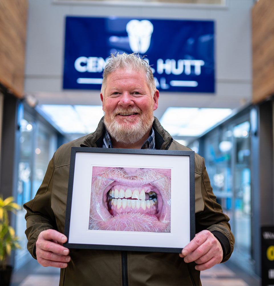 patient showing a before photo of his teeth before his dental implant procedure