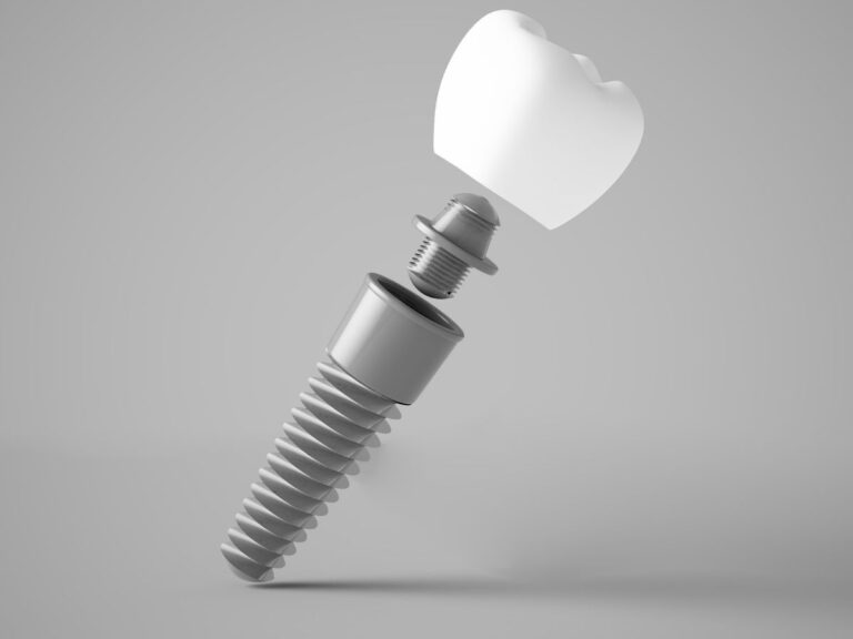 Single Tooth Implant