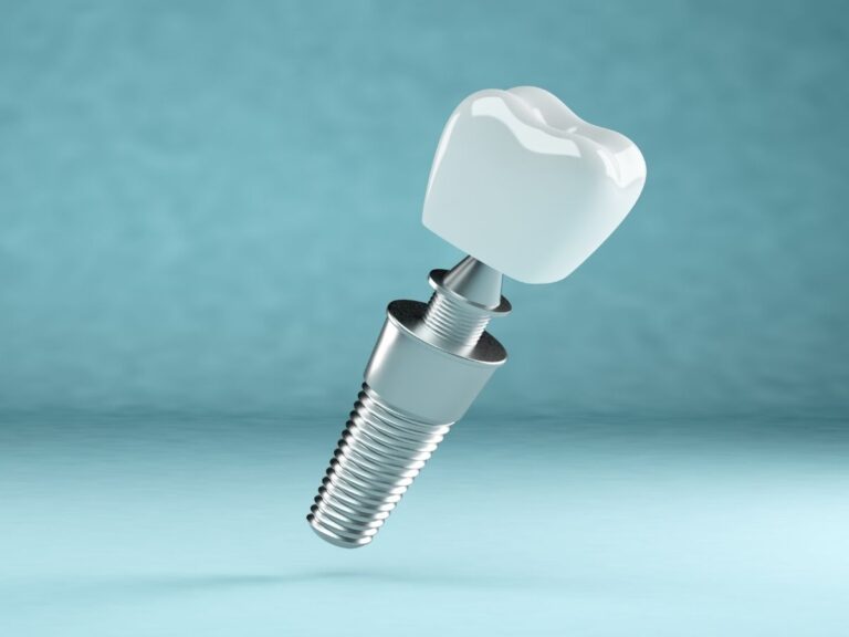 Single Tooth Implant
