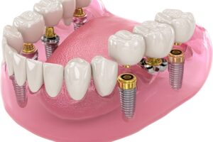 Common Myths About Full Mouth Dental Implants, Debunked