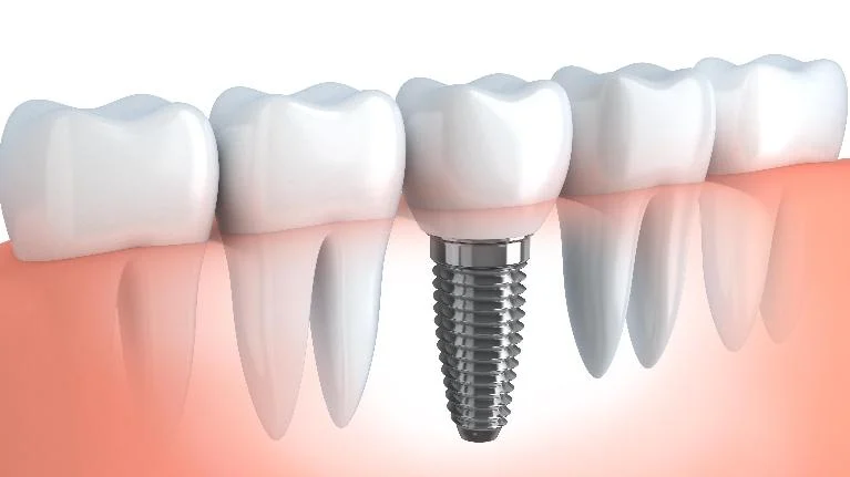 medium_What-Goes-into-a-Dental-Implant-3-Things-to-Expect