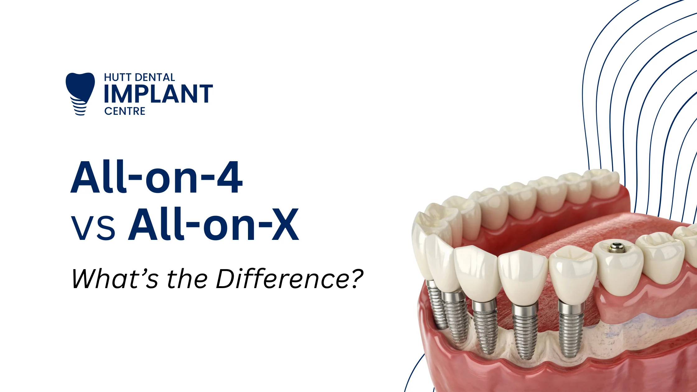 All-on-4 vs All-on-X