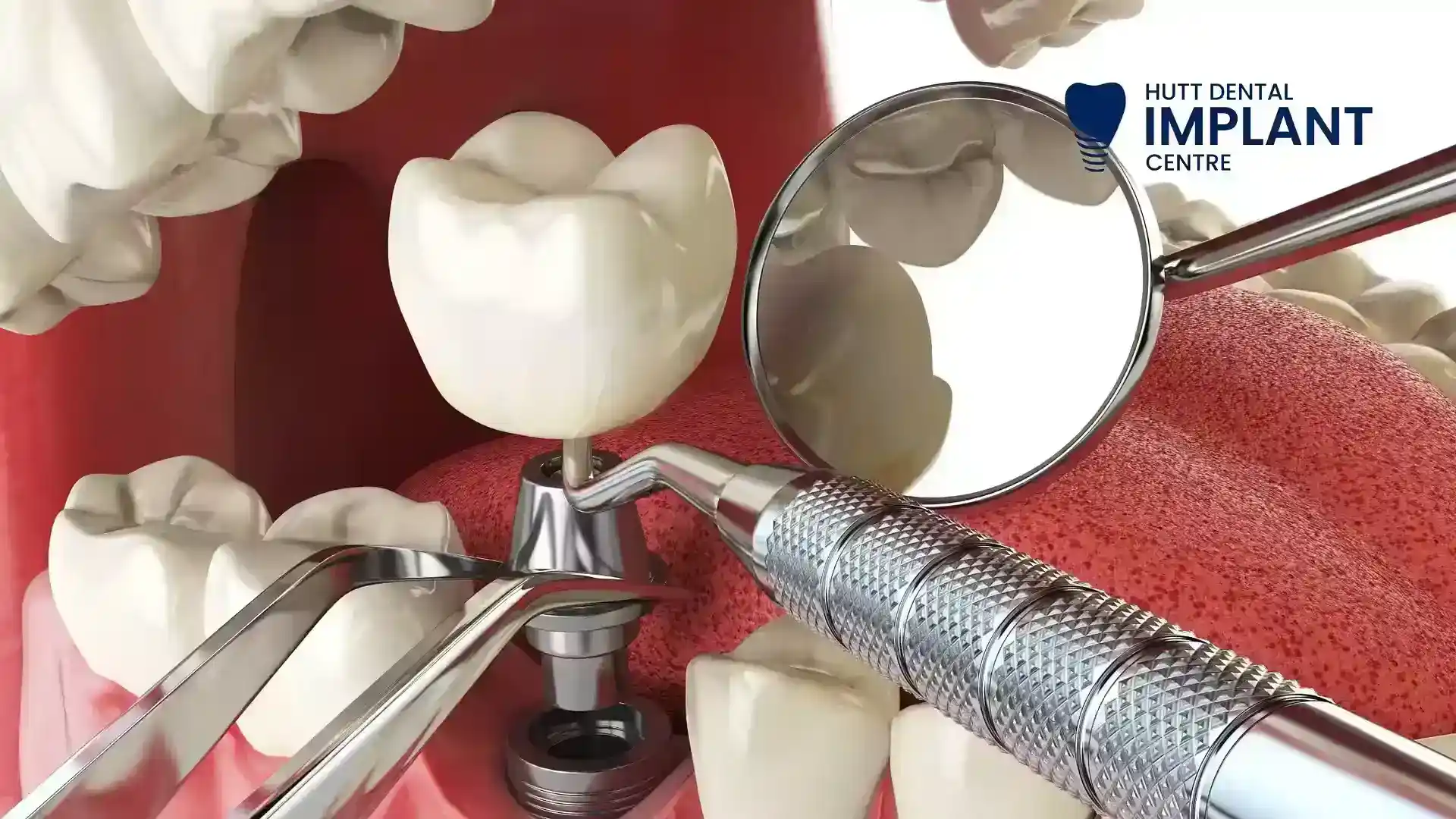 HDIC - Single Dental Implants in New Zealand